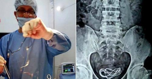 الهند .. إزالة شاحن هاتف طوله 60 سم من مثانة شاب «صور»